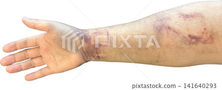 Internal bleeding and subcutaneous hematoma spreading from the wrist to the forearm after catheter treatment (transparent background PNG) Internal bleeding and subcutaneous hematoma spreading from the wrist to the forearm after catheter treatment (transparent background PNG) 141640293