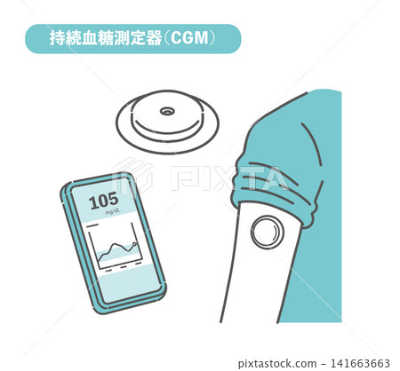 連續血糖監測儀(CGM)插圖集 連續血糖監測儀(CGM)插圖集 141663663