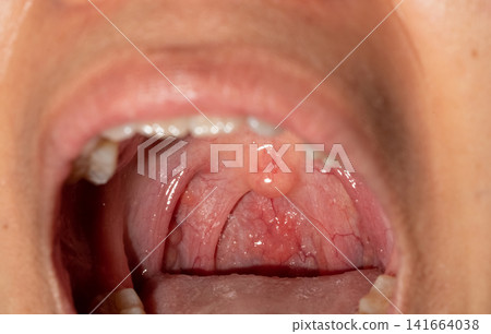 Close up of sore throat with swollen uvula, inflamed posterior pharyngeal wall and visible lymphoid follicles inside the oral cavity. Upper respiratory tract infection and healthcare concepts. Close up of sore throat with swollen uvula, inflamed posterior pharyngeal wall and visible lymphoid follicles inside the oral cavity. Upper respiratory tract infection and healthcare concepts. 141664038