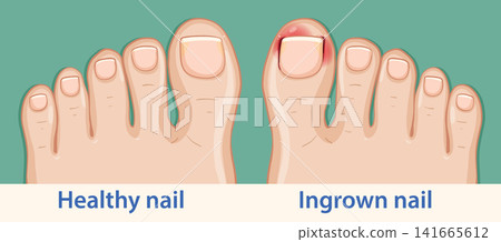 Comparison of Healthy Toenail and Ingrown Toenail Illustration Comparison of Healthy Toenail and Ingrown Toenail Illustration 141665612