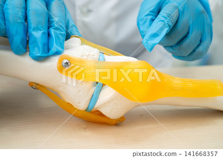 Asian doctor holding spinal nerve and bone model, Lumbar spine displaced herniated disc fragment for treatment medical in the orthopedic department. 141668357