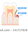牙周炎橫切面：牙菌斑和牙周袋 141717838