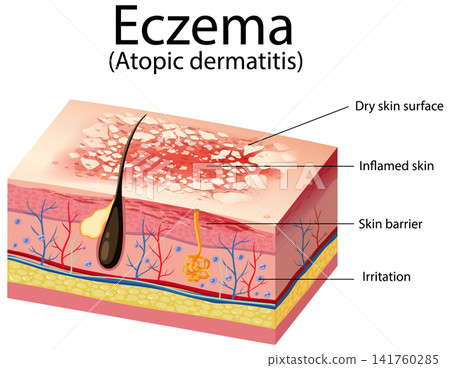 Medical Diagram of Eczema and Atopic Dermatitis Skin Layers 141760285