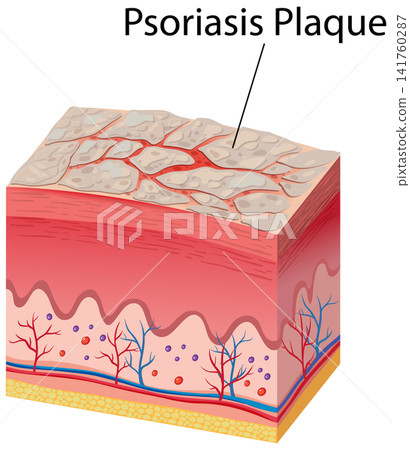 Medical Cross Section Illustration of Psoriasis Plaque on Human Skin Medical Cross Section Illustration of Psoriasis Plaque on Human Skin 141760287