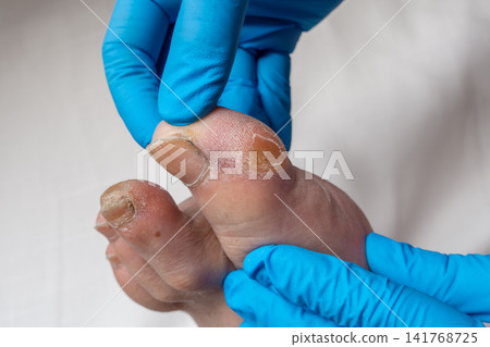 Healthcare Professional Examining Callus on Male Big Toe with Blue Medical Gloves Healthcare Professional Examining Callus on Male Big Toe with Blue Medical Gloves 141768725