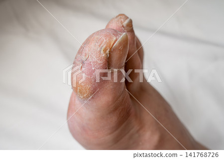 Close-Up of Male Foot with Callus on Big Toe Against White Background Close-Up of Male Foot with Callus on Big Toe Against White Background 141768726