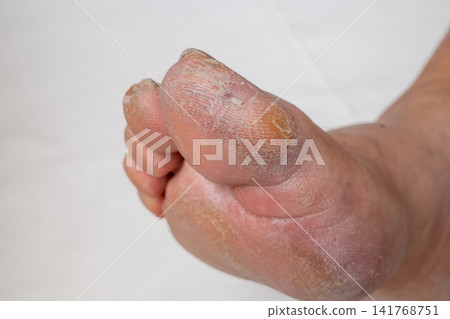 Close-Up of Male Foot with Callus on Big Toe Against White Background Close-Up of Male Foot with Callus on Big Toe Against White Background 141768751