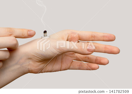 A woman's hand pointing to a burning moxa cone on the back of her hand. A woman's hand pointing to a burning moxa cone on the back of her hand. 141782509