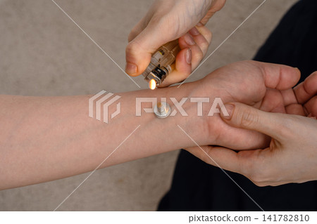 針灸師用打火機點燃了病人手腕上的艾炷。 針灸師用打火機點燃了病人手腕上的艾炷。 141782810