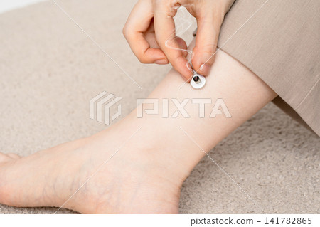 A beige dress and a woman's ankle are shown with a smoke-emitting moxibustion device. A beige dress and a woman's ankle are shown with a smoke-emitting moxibustion device. 141782865