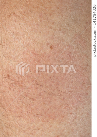 Erythema migrans rash on human skin caused by Lyme disease from a tick bite Erythema migrans rash on human skin caused by Lyme disease from a tick bite 141784326