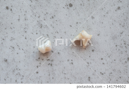 Little white tooth and one big with caries on the stone table. Two milk teeth. Oral care and hygiene. Professional teeth cleaning. Little white tooth and one big with caries on the stone table. Two milk teeth. Oral care and hygiene. Professional teeth cleaning. 141794602