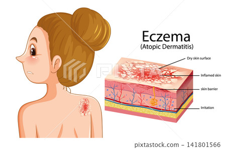Medical Illustration of Eczema and Atopic Dermatitis Skin Condition 141801566