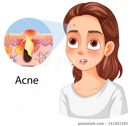 Medical Illustration of Acne with Cross Section of Human Skin Medical Illustration of Acne with Cross Section of Human Skin 141801585