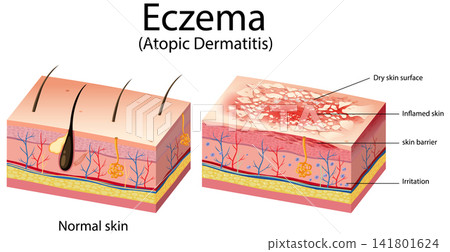 Medical Diagram Comparing Normal Skin and Eczema Atopic Dermatitis Medical Diagram Comparing Normal Skin and Eczema Atopic Dermatitis 141801624