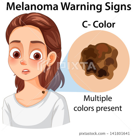Melanoma Warning Signs Illustration Explaining Color Variation in Skin Moles 141801641