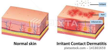 Medical Diagram Comparing Normal Skin and Irritant Contact Dermatitis Medical Diagram Comparing Normal Skin and Irritant Contact Dermatitis 141801659