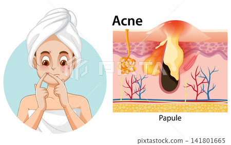 Medical Illustration of Acne Papule Formation and Skin Anatomy Medical Illustration of Acne Papule Formation and Skin Anatomy 141801665