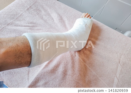 Right foot (right side) immobilized in a cast after surgery for an Achilles tendon rupture. Right foot (right side) immobilized in a cast after surgery for an Achilles tendon rupture. 141820939