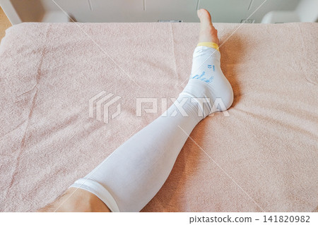 Left leg (right side) wearing compression stockings to prevent blood clots before surgery. Left leg (right side) wearing compression stockings to prevent blood clots before surgery. 141820982