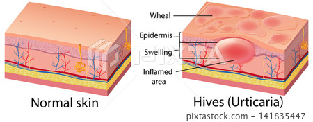 Medical Diagram Comparing Normal Skin and Hives Urticaria Cross Section Medical Diagram Comparing Normal Skin and Hives Urticaria Cross Section 141835447