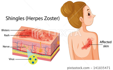 Medical Diagram of Shingles Herpes Zoster Skin Disease and Anatomy Medical Diagram of Shingles Herpes Zoster Skin Disease and Anatomy 141835471