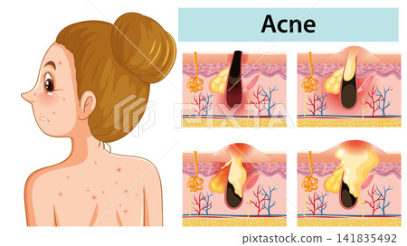 Medical Illustration of Acne Development and Skin Pore Inflammation Medical Illustration of Acne Development and Skin Pore Inflammation 141835492