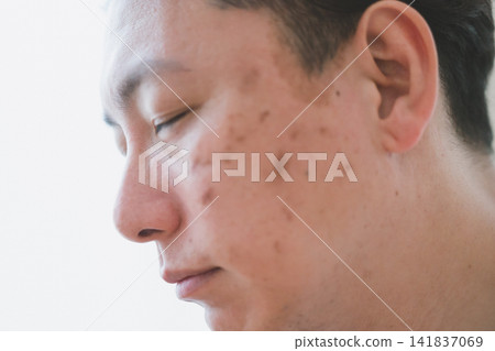 一位40歲的男子,側臉佈滿密集的瑕疵,他閉著眼睛;瑕疵照顧。 一位40歲的男子,側臉佈滿密集的瑕疵,他閉著眼睛;瑕疵照顧。 141837069