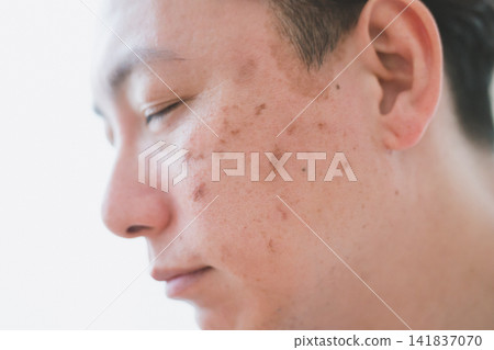 一張40歲男子的側面特寫照片，照片中可以看到他臉頰上佈滿瑕疵，並展示了他的護膚流程。 141837070