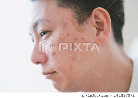 Skin check of a 40-year-old man's profile, noticing blemishes on his cheeks. Skin check of a 40-year-old man's profile, noticing blemishes on his cheeks. 141837071