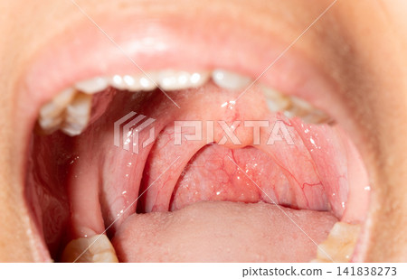 Close up of healthy human throat showing uvula, soft palate and posterior pharyngeal wall inside the oral cavity during routine medical examination for anatomy, healthcare and clinical education. Close up of healthy human throat showing uvula, soft palate and posterior pharyngeal wall inside the oral cavity during routine medical examination for anatomy, healthcare and clinical education. 141838273