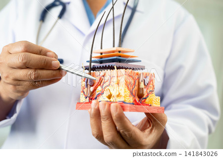 Hair transplant, Asian dermatologist doctor holding skin structure anatomy model for treatment in hospital. Hair transplant, Asian dermatologist doctor holding skin structure anatomy model for treatment in hospital. 141843026