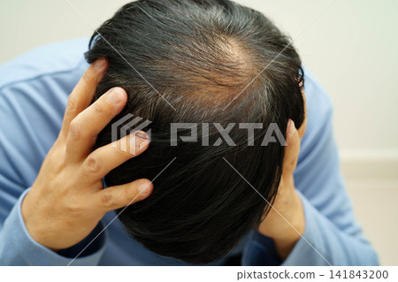 Bald in the middle head and begin no loss hair glabrous of mature man. Bald in the middle head and begin no loss hair glabrous of mature man. 141843200