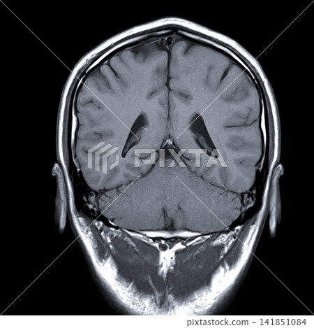 MRI cross-sectional images of the brain viewed from the front. MRI cross-sectional images of the brain viewed from the front. 141851084