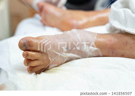 Close up of an injured foot wrapped medical gauze while patient rests hospital bed representing wound care treatment recovery healthcare Close up of an injured foot wrapped medical gauze while patient rests hospital bed representing wound care treatment recovery healthcare 141856507
