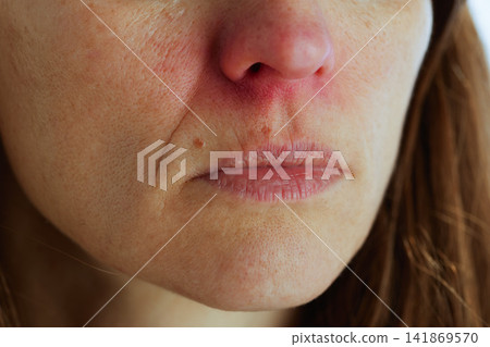 Woman with Sore Red Nose and Dry Chapped Lips Woman with Sore Red Nose and Dry Chapped Lips 141869570