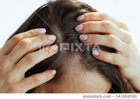 Close-Up of Scalp with Dandruff Flakes Close-Up of Scalp with Dandruff Flakes 141869580