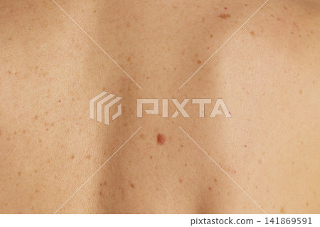 Close-up of Skin Texture with Mole and Freckles Close-up of Skin Texture with Mole and Freckles 141869591