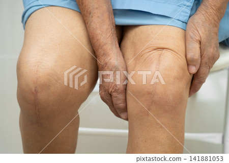 Asian elderly woman patient with scar knee replacement surgery in hospital. Asian elderly woman patient with scar knee replacement surgery in hospital. 141881053