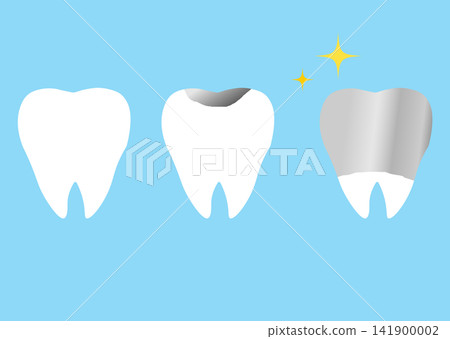 Illustration of a dental crown (silver tooth) Illustration of a dental crown (silver tooth) 141900002