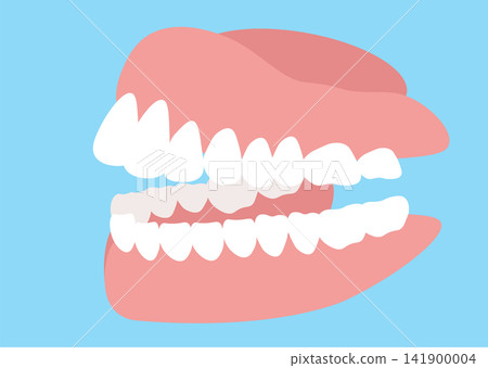 Illustration of a sideways denture (complete denture) Illustration of a sideways denture (complete denture) 141900004