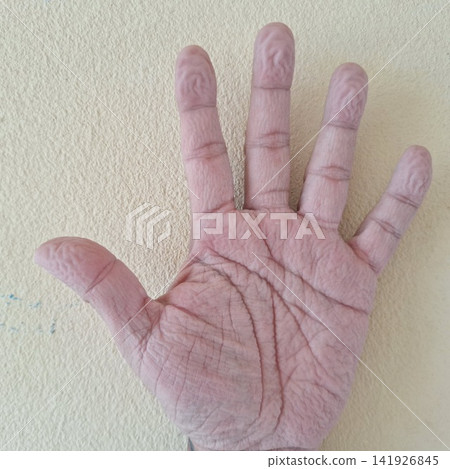Close-up hand shows wrinkled fingertips and palm lines after prolonged water immersion exposure Close-up hand shows wrinkled fingertips and palm lines after prolonged water immersion exposure 141926845