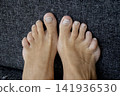 Damaged nails after a pedicur or wearing the wrong shoes 141936530