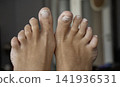 Damaged nails after a pedicur or wearing the wrong shoes 141936531