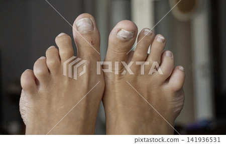 Damaged nails after a pedicur or wearing the wrong shoes Damaged nails after a pedicur or wearing the wrong shoes 141936531