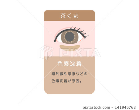 不同類型黑眼圈(棕色眼圈)的圖示:色素沉澱及解釋。 不同類型黑眼圈(棕色眼圈)的圖示:色素沉澱及解釋。 141946768