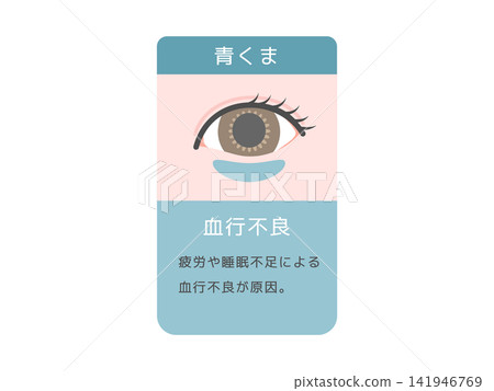 不同類型黑眼圈(藍色圓圈)的圖示:血液循環不良及解釋。 不同類型黑眼圈(藍色圓圈)的圖示:血液循環不良及解釋。 141946769