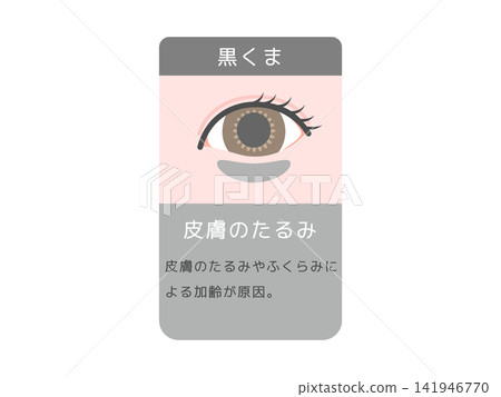 不同類型眼下黑眼圈(黑眼圈)、皮膚鬆弛的插圖及說明文字。 不同類型眼下黑眼圈(黑眼圈)、皮膚鬆弛的插圖及說明文字。 141946770