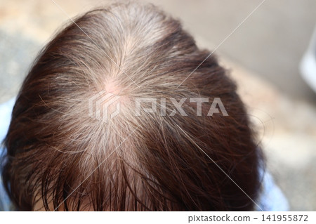 Thinning hair and graying hair on the crown of the head and scalp in senior women. Thinning hair and graying hair on the crown of the head and scalp in senior women. 141955872