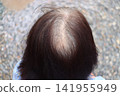 Close-up of thinning hair and gray hair on the crown of a senior woman's head, where the scalp is visible. 141955949